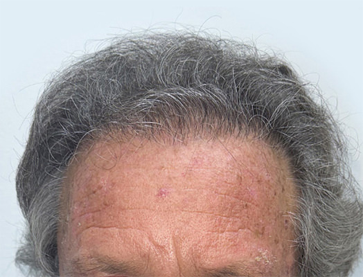 hair transplant photos