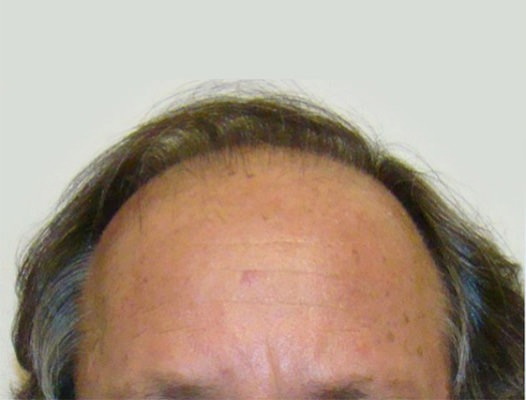 hair transplant photos