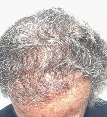 hair transplant photos