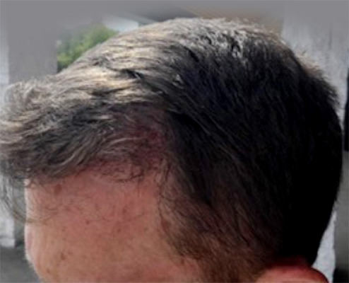 hair transplant photos