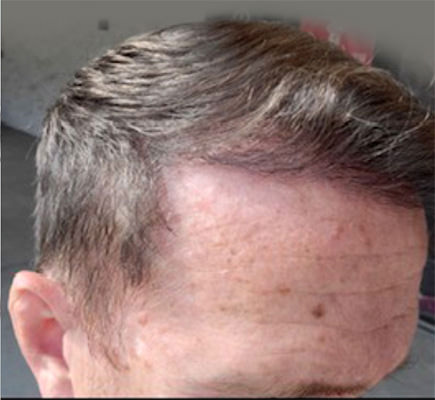 hair transplant photos