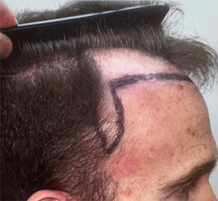 hair transplant photos