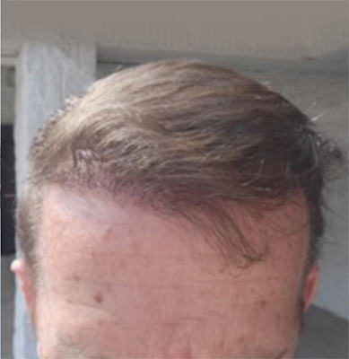 hair transplant photos