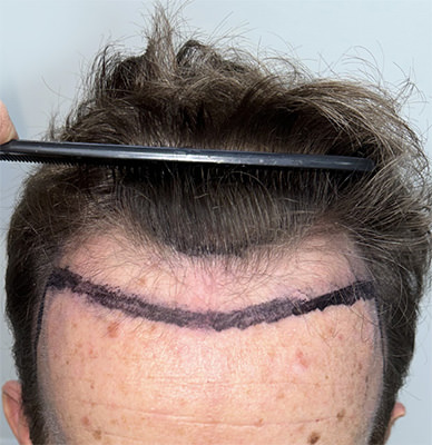 hair transplant photos