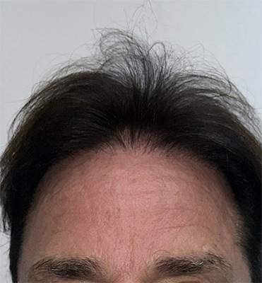 hair transplant photos