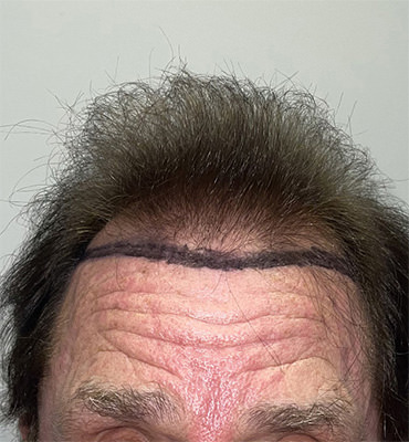 hair transplant photos