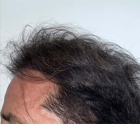 hair transplant photos