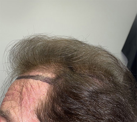 hair transplant photos