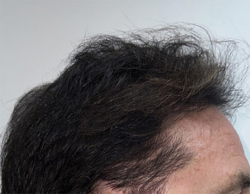 hair transplant photos