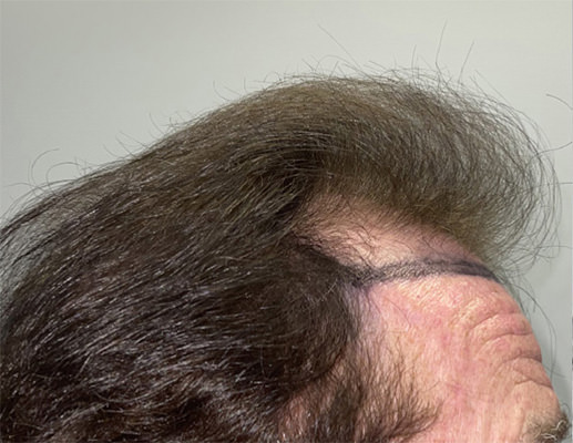 hair transplant photos