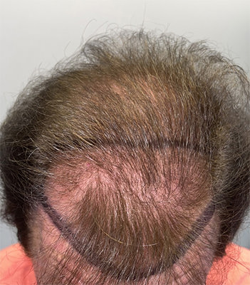 hair transplant photos