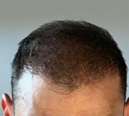 hair transplant photos