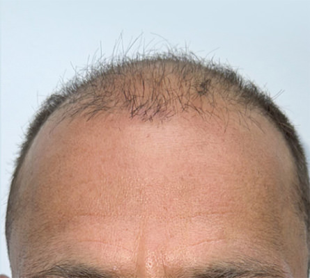 hair transplant photos