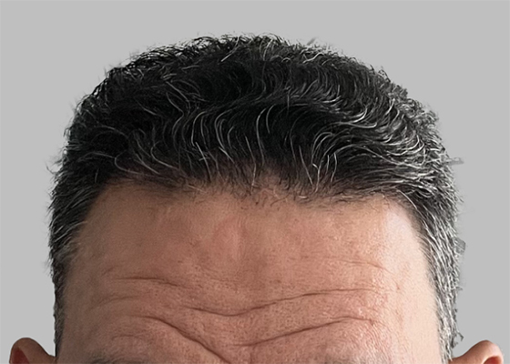 hair transplant photos