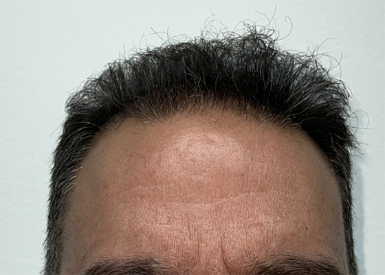 hair transplant photos