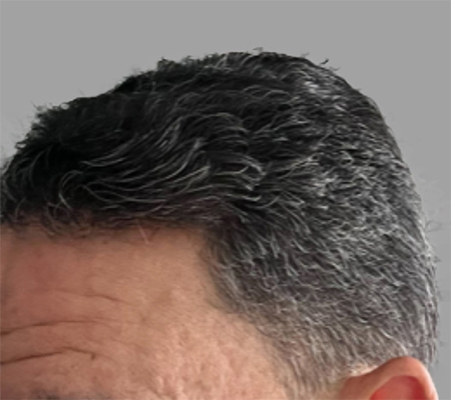 hair transplant photos