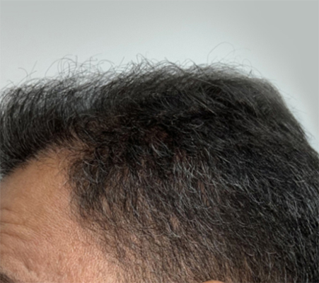 hair transplant photos