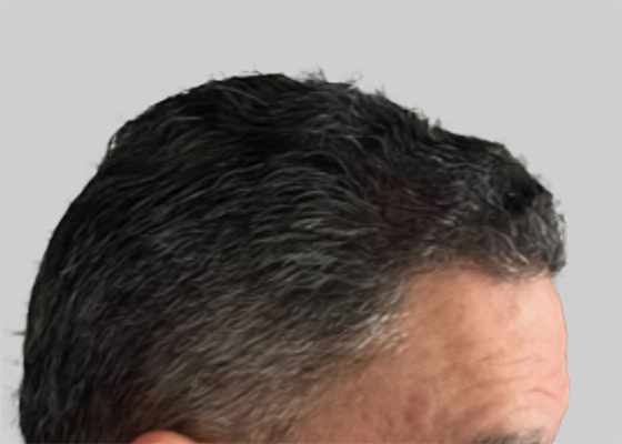 hair transplant photos