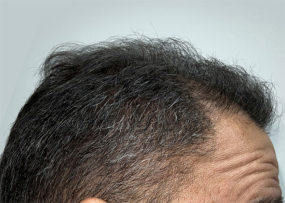 hair transplant photos