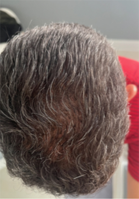 hair transplant photos