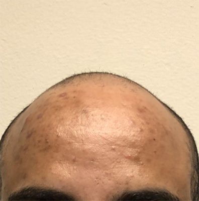 hair transplant photos