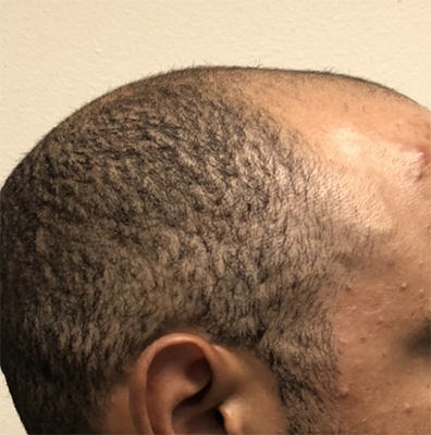 hair transplant photos