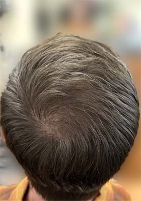 hair transplant photos