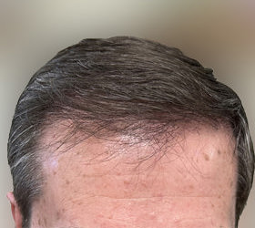 hair transplant photos