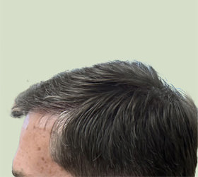 hair transplant photos