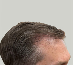 hair transplant photos