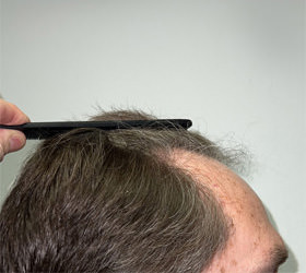 hair transplant photos