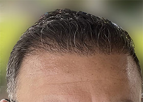 hair transplant photos