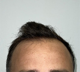 hair transplant photos