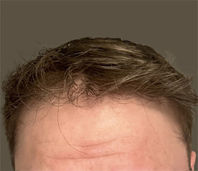 hair transplant photos