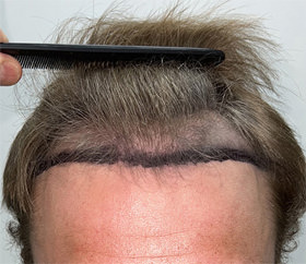 hair transplant photos