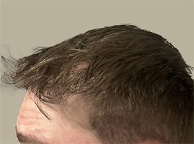 hair transplant photos