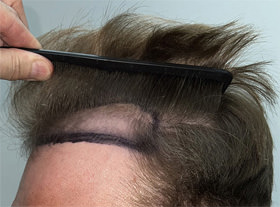 hair transplant photos