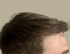 hair transplant photos