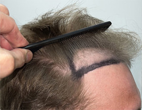 hair transplant photos