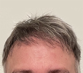 hair transplant photos