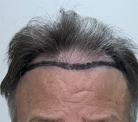 hair transplant photos