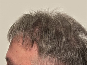 hair transplant photos