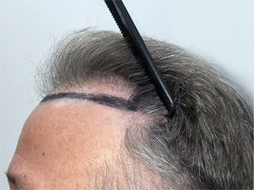 hair transplant photos