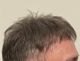 hair transplant photos