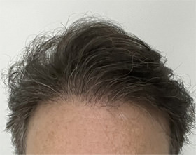 hair transplant photos