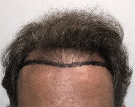 hair transplant photos