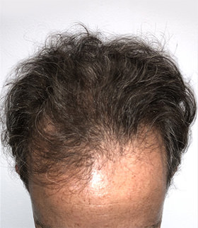 hair transplant photos