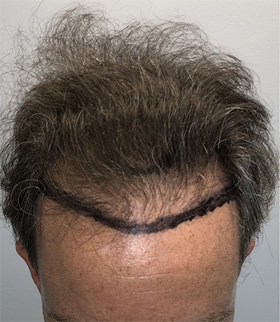 hair transplant photos