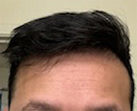 hair transplant photos