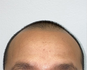 hair transplant photos